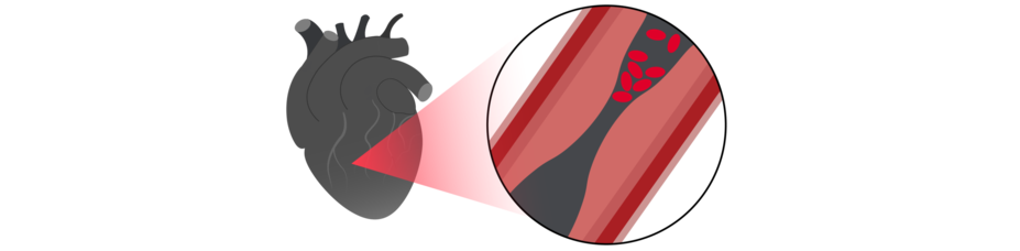 Icon of heart and blood vessel to show cardiovascular disease.