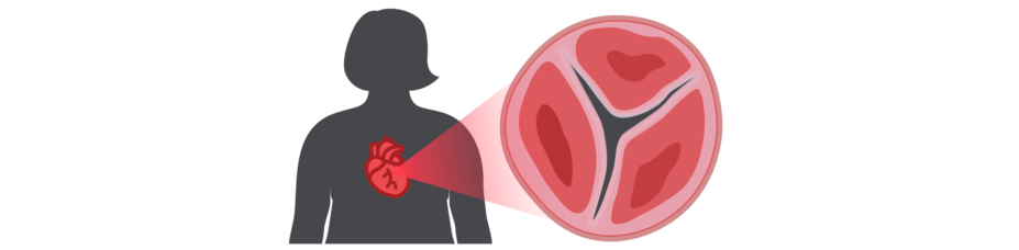 Icon of patient with aortic valve stenosis